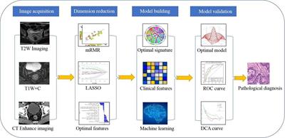 Machine Learning-Based Radiomics Nomogram for Detecting Extramural Venous Invasion in Rectal Cancer